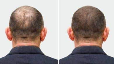 زراعة الشعر بالتقسيط في الإمارات