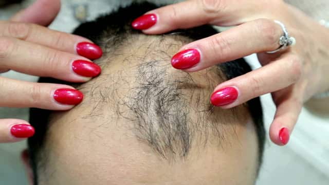 زراعة الشعر في أبوظبي