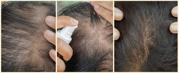 علاج الشعر بالخلايا الجذعية في أبوظبي
